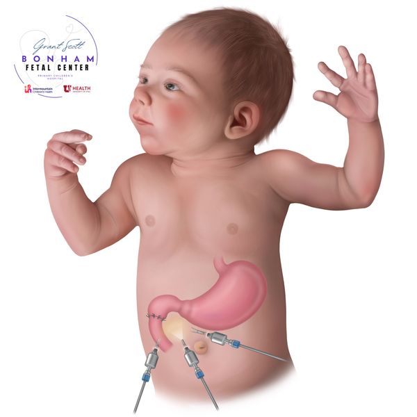 Child undergoing lap repair of duodenal atresia at Primary Childrens Hospital in Salt Lake City,Utah