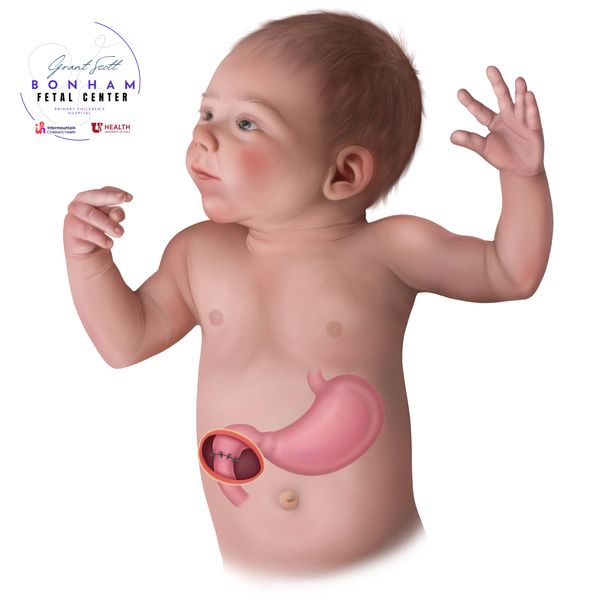 Child undergoing open repair of duodenal atresia at Primary Childrens Hospital in Salt Lake City