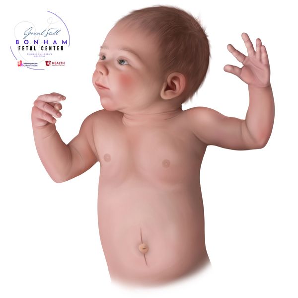 Child with omphalocele treated at the Grant Scott Bonham Fetal Center at Primary Childrens Hospital