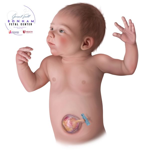 Child with omphalocele treated at the Grant Scott Bonham Fetal Center at Primary Childrens Hospital