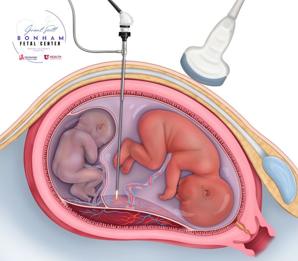 Twins undergoing fetal surgery for TTTS at the Grant Scott Bonham Fetal Center in Utah