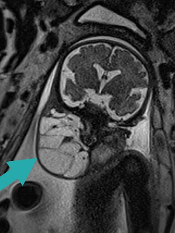 Fetus with cervical teratoma, treated at the Grant Scott Bonham Fetal Center in Salt Lake City, Utah