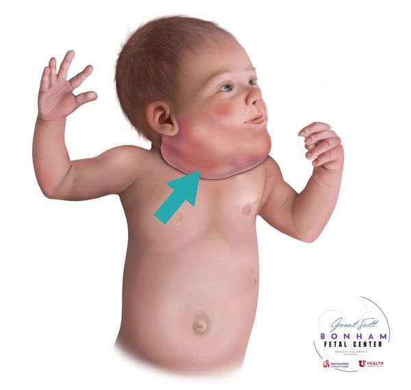 Child with cervical teratoma, treated at the Grant Scott Bonham Fetal Center in Salt Lake City, Utah