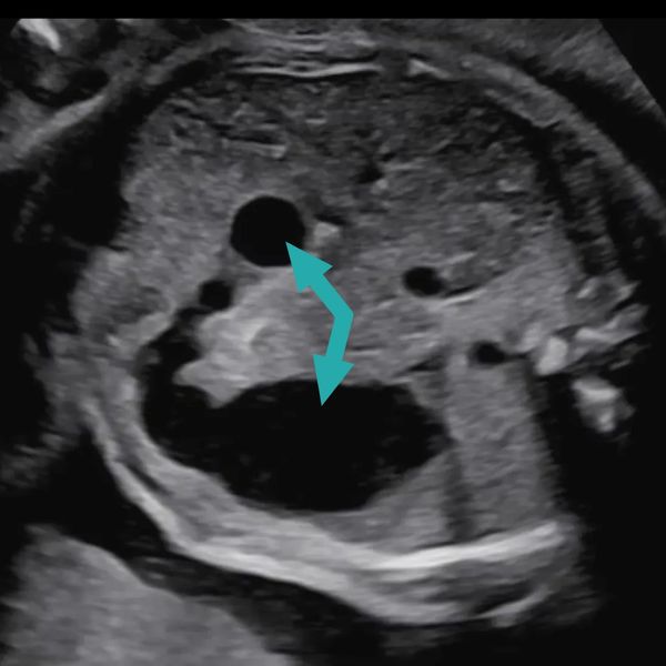 Ultrasound of fetus with duodenal atresia seen at the Grant Scott Bonham Fetal Center in Utah
