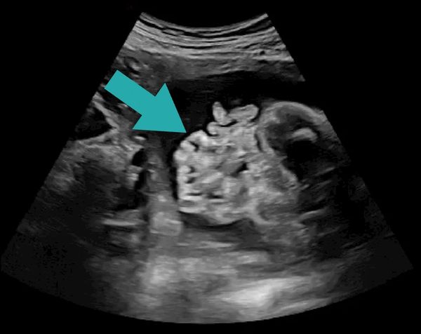 Ultrasound of a fetus with gastroschisis cared for at the Grant Scott Bonham Fetal Center in Utah.
