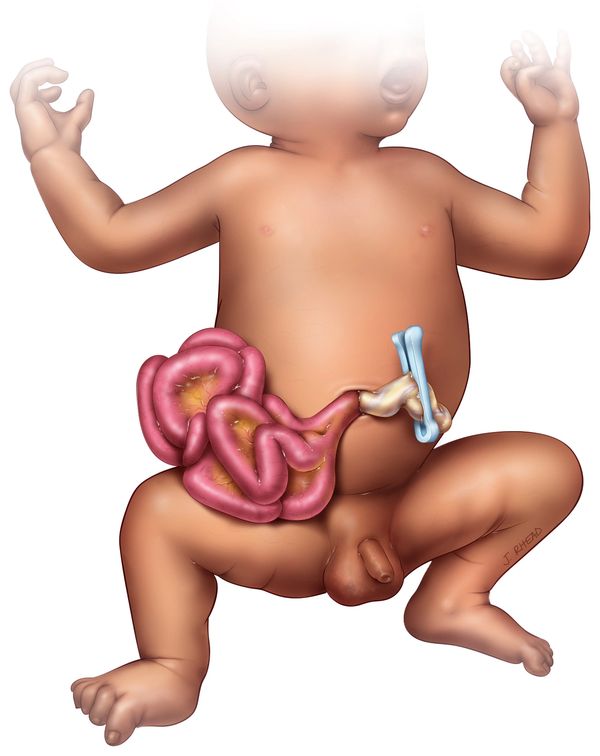 A baby with gastroschisis cared for at Primary Childrens Hospital in Salt Lake City, Utah