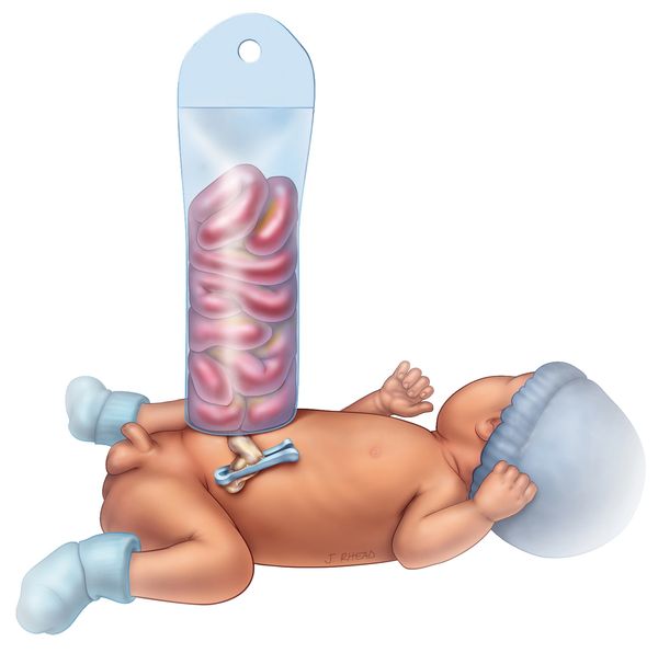 A baby with gastroschisis in a silo cared for at Primary Childrens Hospital in Salt Lake City, Utah