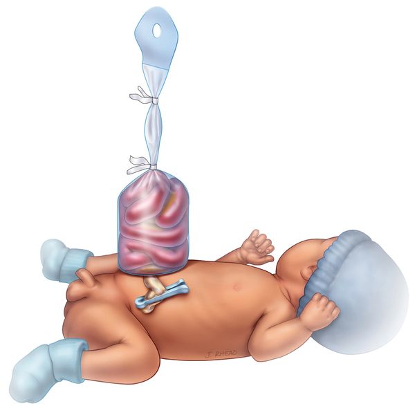 A baby with gastroschisis in a silo cared for at Primary Childrens Hospital in Salt Lake City, Utah