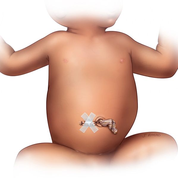A baby with gastroschisis cared for at Primary Childrens Hospital in Salt Lake City, Utah