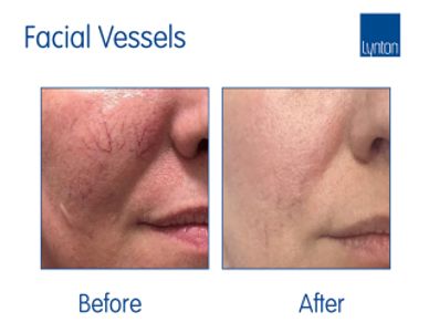 Facial Vessels After before image