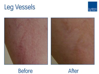 Leg vessels After before image