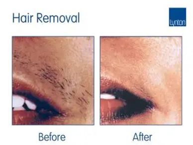 Hair removal after before image