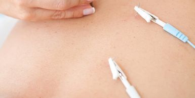 electrostimulation leads clipped to acupuncture needles on a persons shoulder