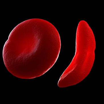 Sickle Cell 3D