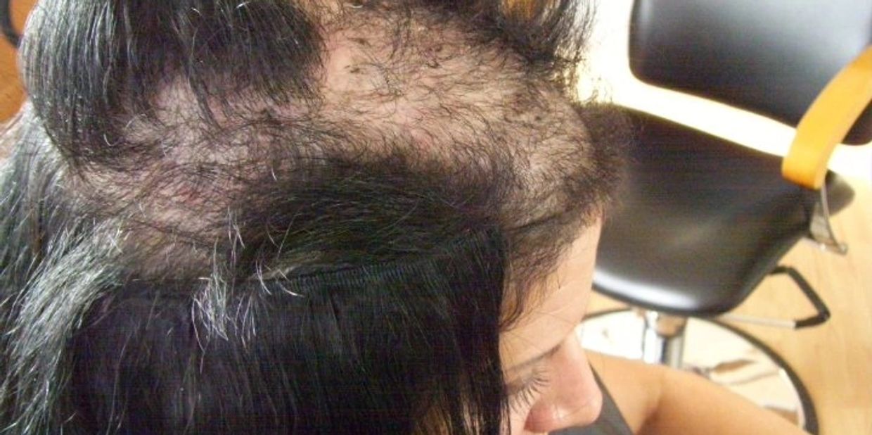 Client suffering from Trichotillomania