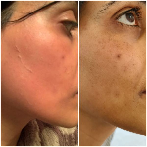pigmentation, post inflammatory, PIH,