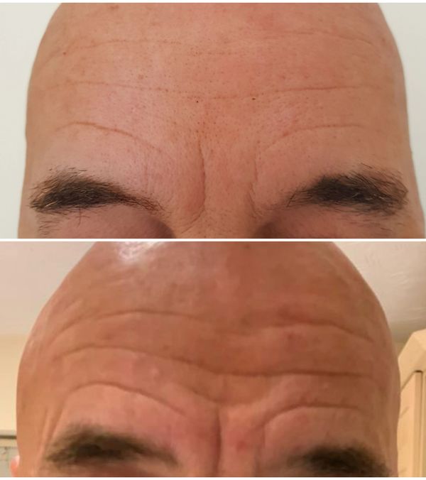 botox, antiwrinkle, jaw, sweating, necklift, frowns, crows feet