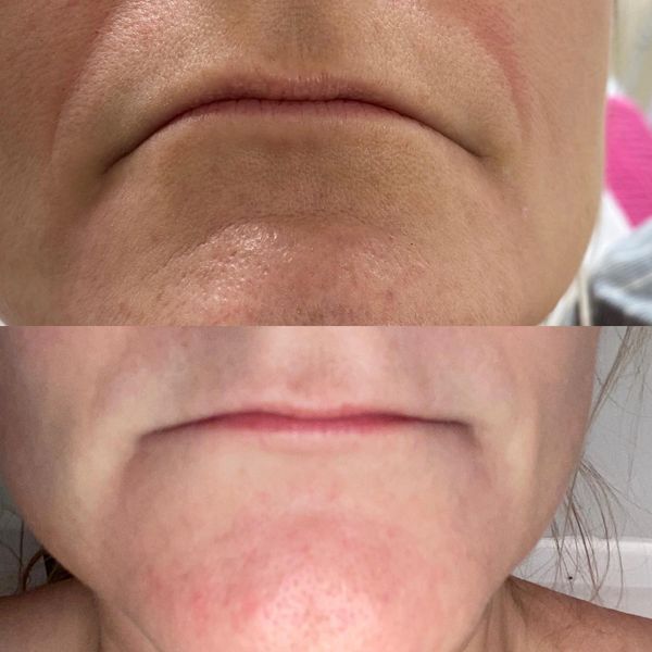 botox, antiwrinkle, jaw, sweating, necklift, frowns, crows feet, downturn mouth