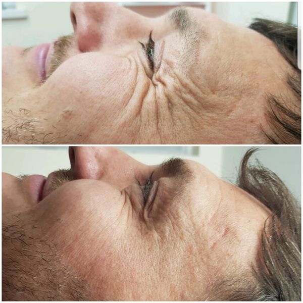 crows feet, botox, antiwrinkle,