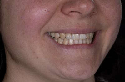 Photo of young woman lower half of face smiling.