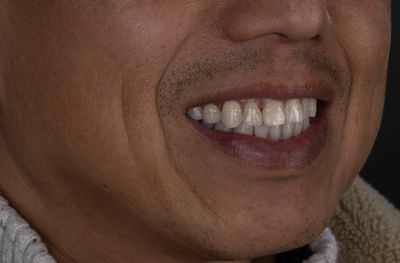 Man smiling, lower half of face.
