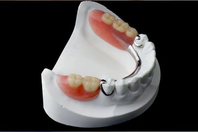 A typical metal framework removable partial denture.