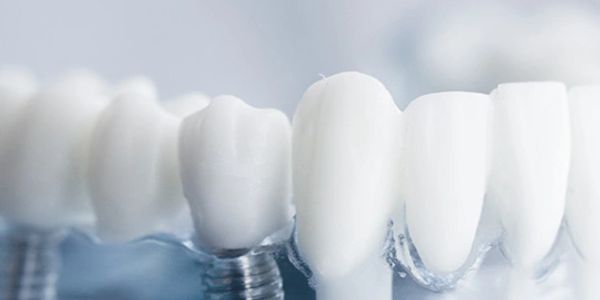 Close-up of dental implants and natural teeth model.