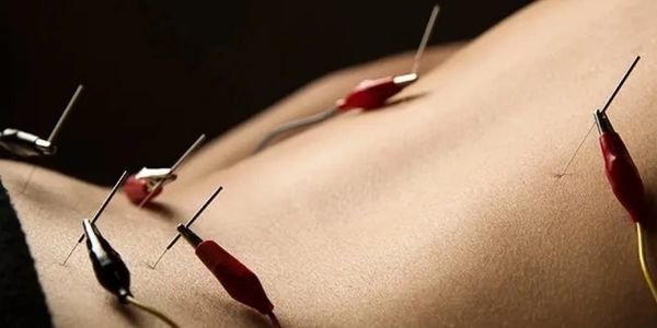 electroacupuncture of lower back