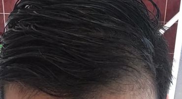 Patches of baldness appearing