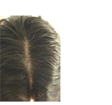 Hair thinning