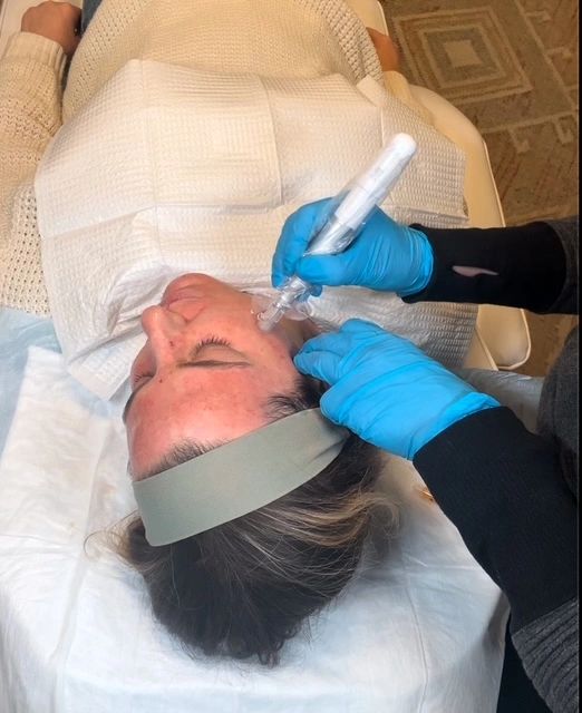 Microneedling treatment at MOTOX skin science in Portland Maine