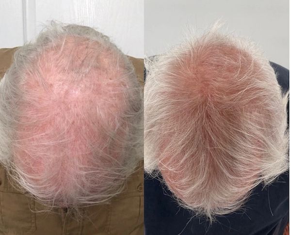 Hair loss portland maine