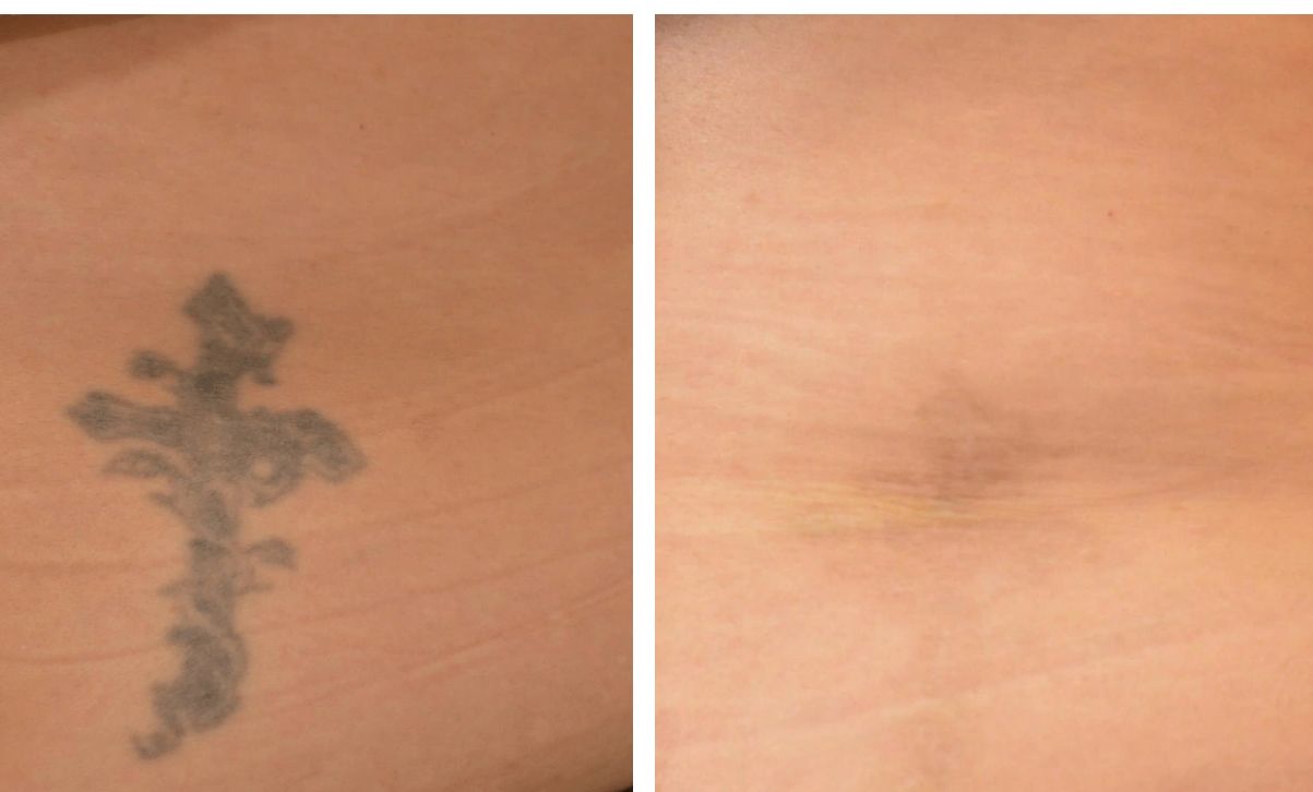 Pico Laser Tattoo Removal Before & After