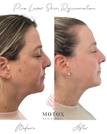 Pico Laser before & after showing reduced dark spots at MOTOX skin science in South Portland, Maine