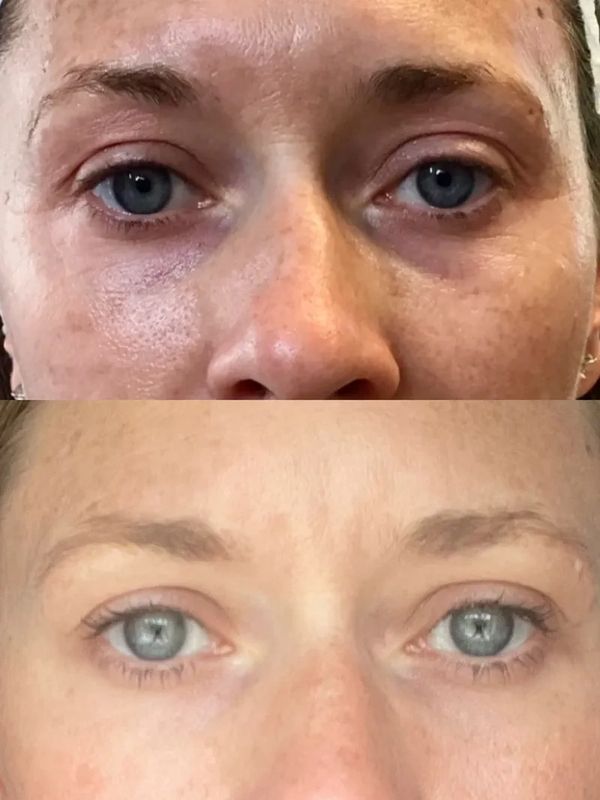 dark circles under eyes portland maine