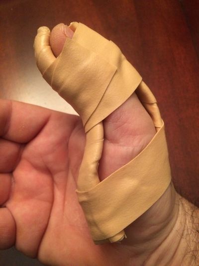 The  splint that inspired a new tool.