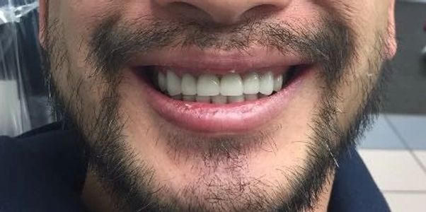 Shu Dental lab- teeth transformation After