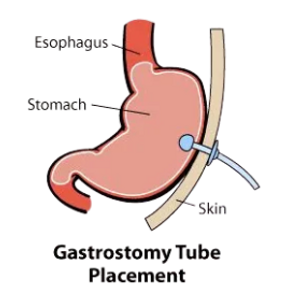 gastrostomy