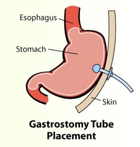 gastrostomy
