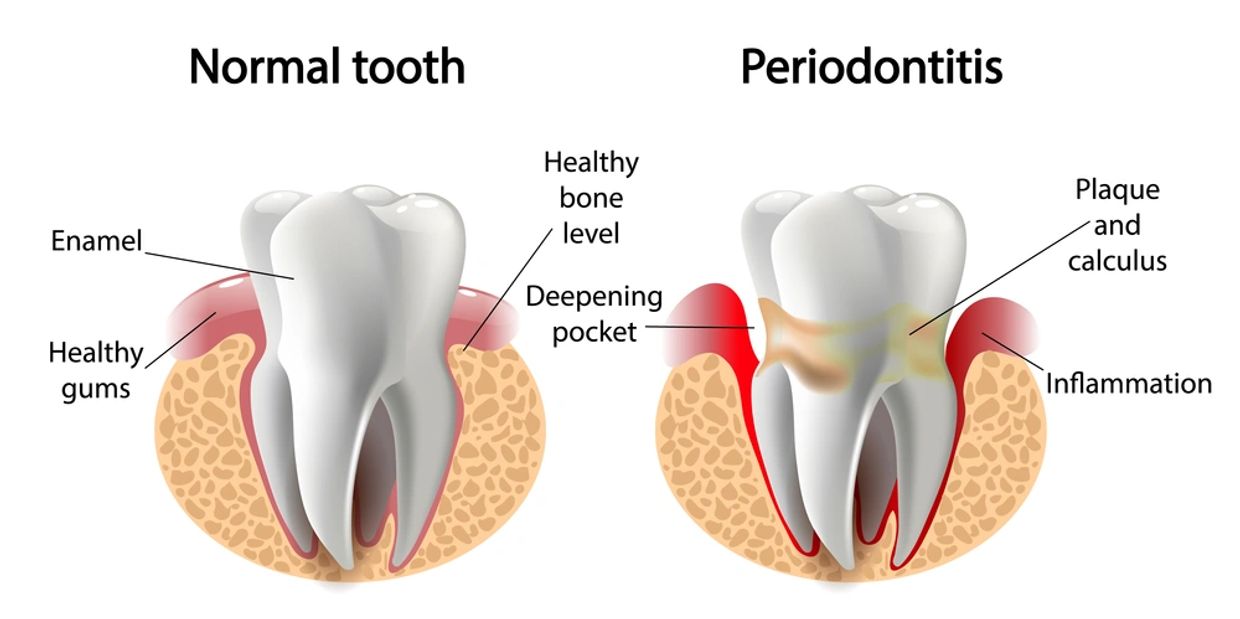 Healthy tooth vs. tooth with periodontitis.