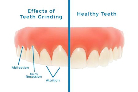 Teeth grinding.  Flat edges on teeth.