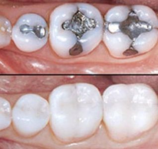 Replacing old amalgam fillings with white composite.