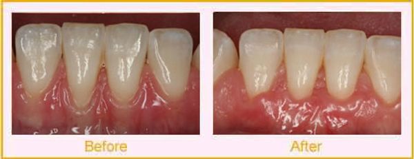 Before and after gum grafting.