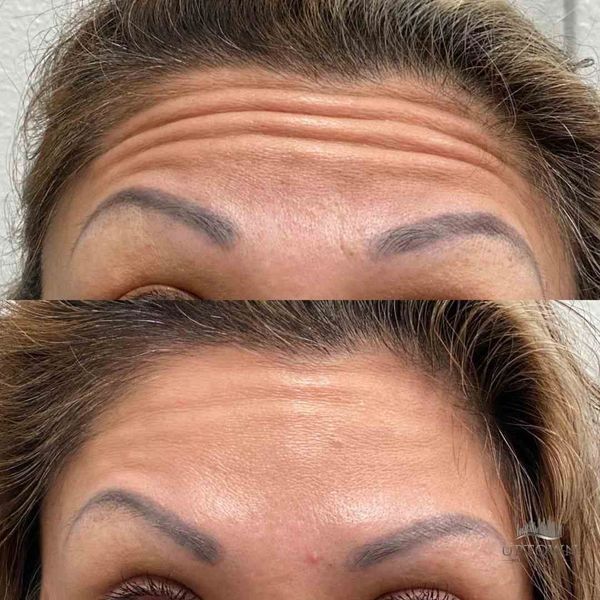 Reduce wrinkles and fine lines with BOTOX®
