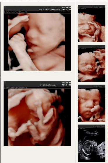 collage of 3d and 5d ultrasound images at 4d baby studio