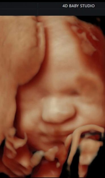 3d ultrasound image of baby's face Phoenix AZ 4Dbaby Studio