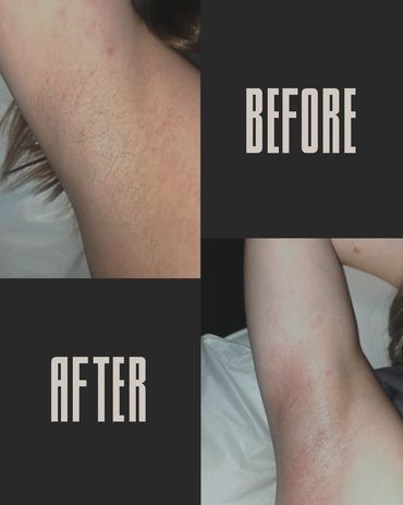 Before & After UnderArm Wax