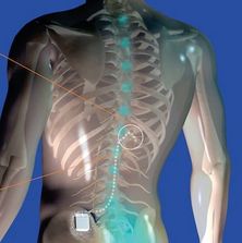 IVs infusions for back pain and other chronic issues