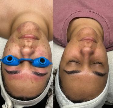 Before and after of skin pigmentation with chemical peels