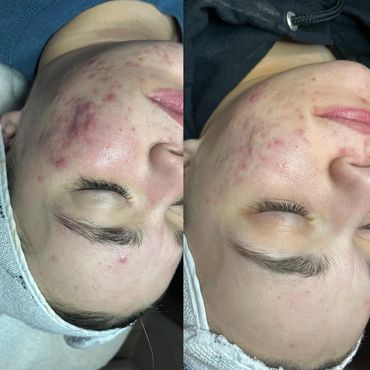 Clearing up acne with chemical peels and skincare